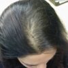 Telogen Effluvium Hair Loss